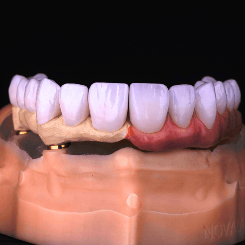 Trillor implant dentures offer a strong, lightweight full-arch option with natural, durable results.